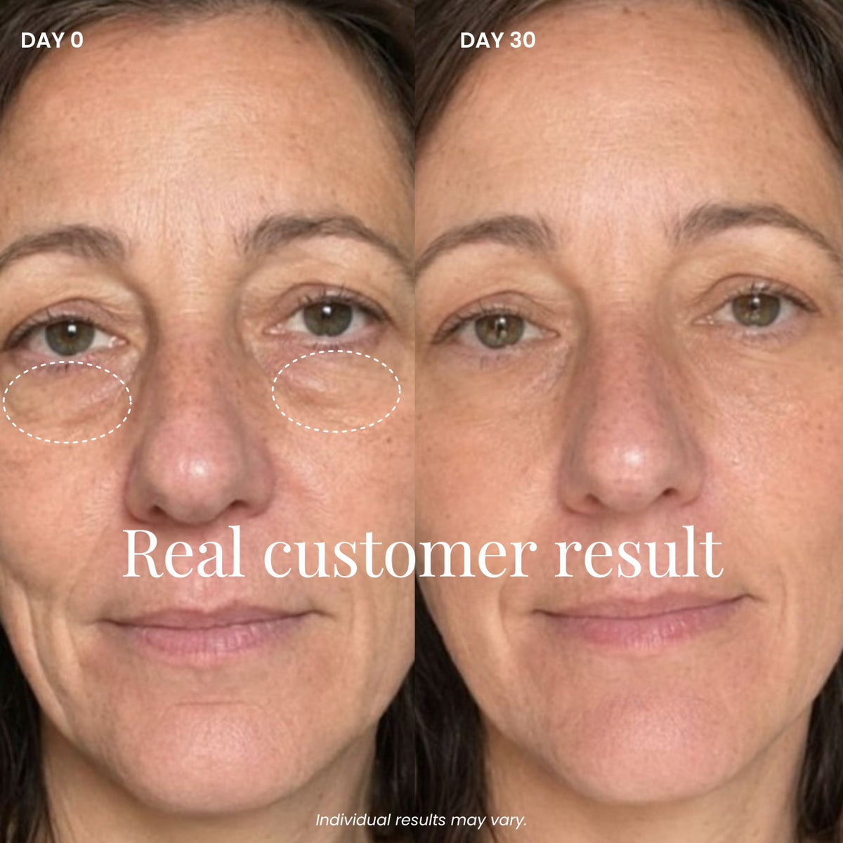 Auréa™ Precision LED Skincare Wand